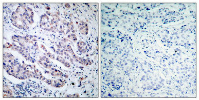 Immunohistochemical analysis of paraffin-embedded human breast carcinoma tissue using TYK2(Ab-1054) Antibody(left) or the same antibody preincubated with blocking peptide(right).