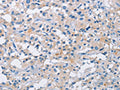The image on the left is immunohistochemistry of paraffin-embedded Human thyroid cancer tissue using CSB-PA906170(ATP6AP2 Antibody) at dilution 1/50, on the right is treated with fusion protein. (Original magnification: ×200)