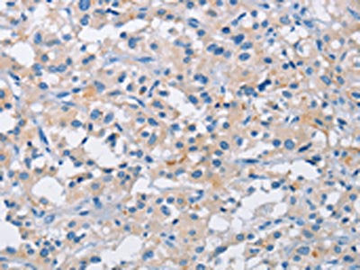 The image on the left is immunohistochemistry of paraffin-embedded Human thyroid cancer tissue using CSB-PA906170(ATP6AP2 Antibody) at dilution 1/50, on the right is treated with fusion protein. (Original magnification: ×200)
