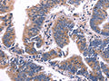 The image on the left is immunohistochemistry of paraffin-embedded Human colon cancer tissue using CSB-PA906268(ARC Antibody) at dilution 1/50, on the right is treated with fusion protein. (Original magnification: ×200)