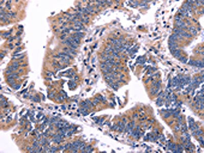 The image on the left is immunohistochemistry of paraffin-embedded Human colon cancer tissue using CSB-PA906268(ARC Antibody) at dilution 1/50, on the right is treated with fusion protein. (Original magnification: ×200)