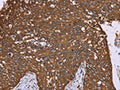 The image on the left is immunohistochemistry of paraffin-embedded Human cervical cancer tissue using CSB-PA906437(PPIB Antibody) at dilution 1/40, on the right is treated with fusion protein. (Original magnification: ×200)
