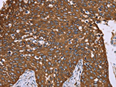 The image on the left is immunohistochemistry of paraffin-embedded Human cervical cancer tissue using CSB-PA906437(PPIB Antibody) at dilution 1/40, on the right is treated with fusion protein. (Original magnification: ×200)