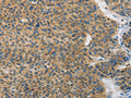 The image on the left is immunohistochemistry of paraffin-embedded Human liver cancer tissue using CSB-PA906762(ANAPC13 Antibody) at dilution 1/25, on the right is treated with fusion protein. (Original magnification: ×200)