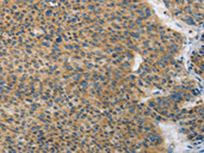 The image on the left is immunohistochemistry of paraffin-embedded Human liver cancer tissue using CSB-PA906762(ANAPC13 Antibody) at dilution 1/25, on the right is treated with fusion protein. (Original magnification: ×200)
