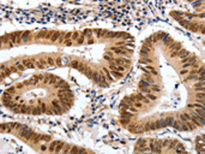 The image on the left is immunohistochemistry of paraffin-embedded Human colon cancer tissue using CSB-PA906808(MSH3 Antibody) at dilution 1/30, on the right is treated with fusion protein. (Original magnification: ×200)