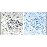 Immunohistochemistry analysis of paraffin-embedded human lung carcinoma tissue using CPNE8 antibody.