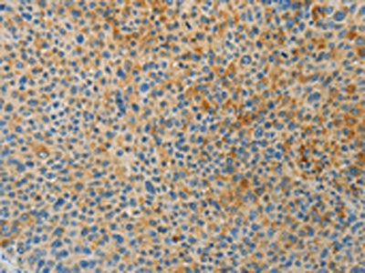 The image on the left is immunohistochemistry of paraffin-embedded Human liver cancer tissue using CSB-PA907155(BAAT Antibody) at dilution 1/30, on the right is treated with fusion protein. (Original magnification: ×200)