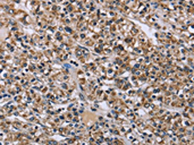 The image on the left is immunohistochemistry of paraffin-embedded Human prostate cancer tissue using CSB-PA907180(KCNJ11 Antibody) at dilution 1/40, on the right is treated with fusion protein. (Original magnification: ×200)