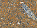 The image on the left is immunohistochemistry of paraffin-embedded Human cervical cancer tissue using CSB-PA907505(KLC1 Antibody) at dilution 1/40, on the right is treated with fusion protein. (Original magnification: ×200)