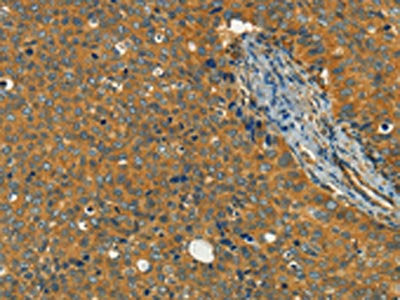 The image on the left is immunohistochemistry of paraffin-embedded Human cervical cancer tissue using CSB-PA907505(KLC1 Antibody) at dilution 1/40, on the right is treated with fusion protein. (Original magnification: ×200)