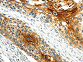 The image on the left is immunohistochemistry of paraffin-embedded Human esophagus cancer tissue using CSB-PA907686(GRB2 Antibody) at dilution 1/25, on the right is treated with fusion protein. (Original magnification: ×200)