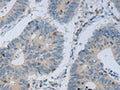 The image on the left is immunohistochemistry of paraffin-embedded Human colon cancer tissue using CSB-PA907852(MAGEB4 Antibody) at dilution 1/40, on the right is treated with fusion protein. (Original magnification: ×200)
