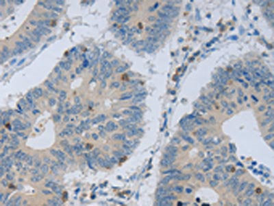 The image on the left is immunohistochemistry of paraffin-embedded Human colon cancer tissue using CSB-PA907852(MAGEB4 Antibody) at dilution 1/40, on the right is treated with fusion protein. (Original magnification: ×200)