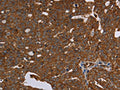 The image on the left is immunohistochemistry of paraffin-embedded Human ovarian cancer tissue using CSB-PA907912(HSD17B13 Antibody) at dilution 1/30, on the right is treated with fusion protein. (Original magnification: ×200)