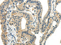 The image on the left is immunohistochemistry of paraffin-embedded Human thyroid cancer tissue using CSB-PA908097(CCL13 Antibody) at dilution 1/40, on the right is treated with synthetic peptide. (Original magnification: ×200)