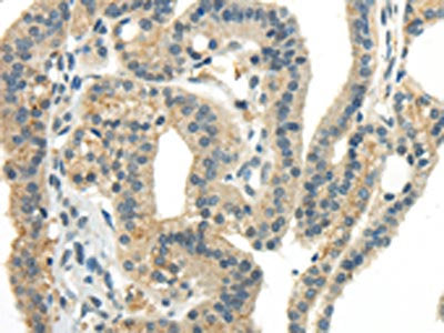The image on the left is immunohistochemistry of paraffin-embedded Human thyroid cancer tissue using CSB-PA908097(CCL13 Antibody) at dilution 1/40, on the right is treated with synthetic peptide. (Original magnification: ×200)