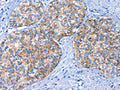 The image on the left is immunohistochemistry of paraffin-embedded Human prostate cancer tissue using CSB-PA908140(BCAM Antibody) at dilution 1/40, on the right is treated with fusion protein. (Original magnification: ×200)