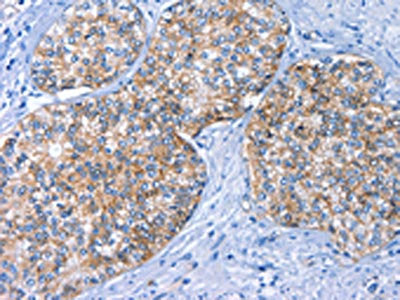 The image on the left is immunohistochemistry of paraffin-embedded Human prostate cancer tissue using CSB-PA908140(BCAM Antibody) at dilution 1/40, on the right is treated with fusion protein. (Original magnification: ×200)