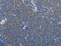 The image on the left is immunohistochemistry of paraffin-embedded Human Lymphoma tissue using CSB-PA908401(AMY2A Antibody) at dilution 1/60, on the right is treated with fusion protein. (Original magnification: ×200)