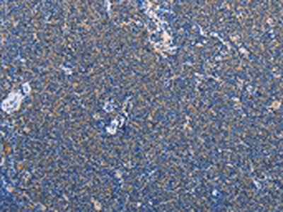 The image on the left is immunohistochemistry of paraffin-embedded Human Lymphoma tissue using CSB-PA908401(AMY2A Antibody) at dilution 1/60, on the right is treated with fusion protein. (Original magnification: ×200)