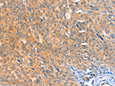 The image on the left is immunohistochemistry of paraffin-embedded Human cervical cancer tissue using CSB-PA908473(ACOX3 Antibody) at dilution 1/25, on the right is treated with fusion protein. (Original magnification: ×200)