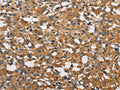 The image on the left is immunohistochemistry of paraffin-embedded Human thyroid cancer tissue using CSB-PA908632(NPPA Antibody) at dilution 1/30, on the right is treated with fusion protein. (Original magnification: ×200)