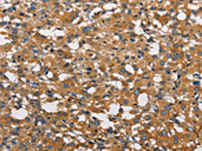 The image on the left is immunohistochemistry of paraffin-embedded Human thyroid cancer tissue using CSB-PA908632(NPPA Antibody) at dilution 1/30, on the right is treated with fusion protein. (Original magnification: ×200)