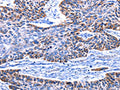 The image on the left is immunohistochemistry of paraffin-embedded Human esophagus cancer tissue using CSB-PA908724(IGF2BP2 Antibody) at dilution 1/15, on the right is treated with fusion protein. (Original magnification: ×200)