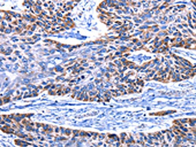 The image on the left is immunohistochemistry of paraffin-embedded Human esophagus cancer tissue using CSB-PA908724(IGF2BP2 Antibody) at dilution 1/15, on the right is treated with fusion protein. (Original magnification: ×200)