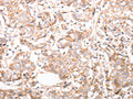 The image on the left is immunohistochemistry of paraffin-embedded Human breast cancer tissue using CSB-PA908796(pan CDH Antibody) at dilution 1/20, on the right is treated with synthetic peptide. (Original magnification: ×200)