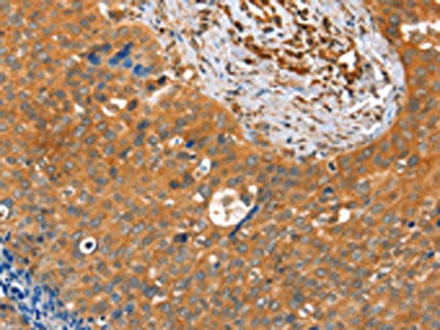 The image on the left is immunohistochemistry of paraffin-embedded Human cervical cancer tissue using CSB-PA908870(ACOT11 Antibody) at dilution 1/25, on the right is treated with fusion protein. (Original magnification: ×200)