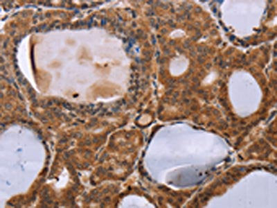 The image on the left is immunohistochemistry of paraffin-embedded Human thyroid cancer tissue using CSB-PA909217(NDUFA2 Antibody) at dilution 1/30, on the right is treated with fusion protein. (Original magnification: ×200)