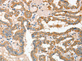 The image on the left is immunohistochemistry of paraffin-embedded Human thyroid cancer tissue using CSB-PA909378(ADAM10 Antibody) at dilution 1/30, on the right is treated with fusion protein. (Original magnification: ×200)