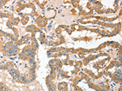 The image on the left is immunohistochemistry of paraffin-embedded Human thyroid cancer tissue using CSB-PA909378(ADAM10 Antibody) at dilution 1/30, on the right is treated with fusion protein. (Original magnification: ×200)