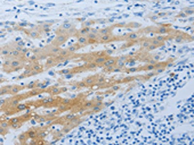 The image on the left is immunohistochemistry of paraffin-embedded Human liver cancer tissue using CSB-PA909441(NPHS1 Antibody) at dilution 1/50, on the right is treated with synthetic peptide. (Original magnification: ×200)