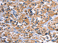 The image on the left is immunohistochemistry of paraffin-embedded Human thyroid cancer tissue using CSB-PA909503(COMP Antibody) at dilution 1/50, on the right is treated with fusion protein. (Original magnification: ×200)