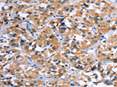 The image on the left is immunohistochemistry of paraffin-embedded Human thyroid cancer tissue using CSB-PA909503(COMP Antibody) at dilution 1/50, on the right is treated with fusion protein. (Original magnification: ×200)