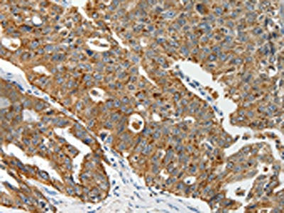 The image on the left is immunohistochemistry of paraffin-embedded Human ovarian cancer tissue using CSB-PA909687(ABCD2 Antibody) at dilution 1/20, on the right is treated with synthetic peptide. (Original magnification: ×200)