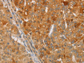 The image on the left is immunohistochemistry of paraffin-embedded Human liver cancer tissue using CSB-PA909692(ARSG Antibody) at dilution 1/30, on the right is treated with fusion protein. (Original magnification: ×200)