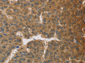 The image on the left is immunohistochemistry of paraffin-embedded Human liver cancer tissue using CSB-PA909727(TNFRSF10D Antibody) at dilution 1/60, on the right is treated with fusion protein. (Original magnification: ×200)