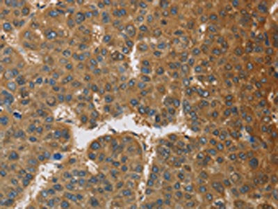 The image on the left is immunohistochemistry of paraffin-embedded Human liver cancer tissue using CSB-PA909727(TNFRSF10D Antibody) at dilution 1/60, on the right is treated with fusion protein. (Original magnification: ×200)