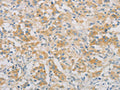 The image on the left is immunohistochemistry of paraffin-embedded Human thyroid cancer tissue using CSB-PA910014(SPTLC1 Antibody) at dilution 1/25, on the right is treated with fusion protein. (Original magnification: ×200)