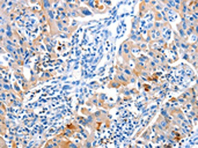 The image on the left is immunohistochemistry of paraffin-embedded Human lung cancer tissue using CSB-PA910215(ACYP1 Antibody) at dilution 1/25, on the right is treated with fusion protein. (Original magnification: ×200)