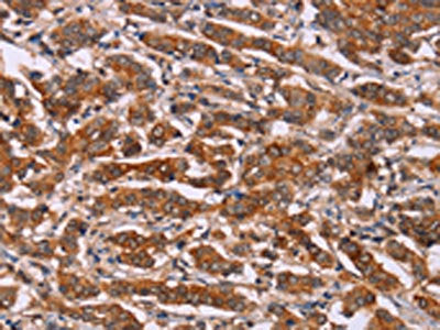 The image on the left is immunohistochemistry of paraffin-embedded Human breast cancer tissue using CSB-PA910505(CYP2W1 Antibody) at dilution 1/25, on the right is treated with fusion protein. (Original magnification: ×200)
