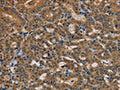 The image is immunohistochemistry of paraffin-embedded Human thyroid cancer tissue using CSB-PA910574(TAB3 Antibody) at dilution 1/35. (Original magnification: ×200)