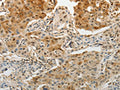 The image on the left is immunohistochemistry of paraffin-embedded Human lung cancer tissue using CSB-PA910720(MGEA5 Antibody) at dilution 1/15, on the right is treated with fusion protein. (Original magnification: ×200)