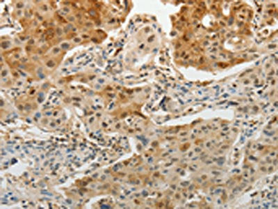 The image on the left is immunohistochemistry of paraffin-embedded Human lung cancer tissue using CSB-PA910720(MGEA5 Antibody) at dilution 1/15, on the right is treated with fusion protein. (Original magnification: ×200)