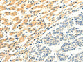 The image on the left is immunohistochemistry of paraffin-embedded Human liver cancer tissue using CSB-PA910765(SPAG5 Antibody) at dilution 1/25, on the right is treated with fusion protein. (Original magnification: ×200)