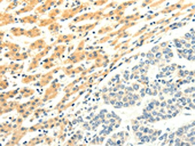 The image on the left is immunohistochemistry of paraffin-embedded Human liver cancer tissue using CSB-PA910765(SPAG5 Antibody) at dilution 1/25, on the right is treated with fusion protein. (Original magnification: ×200)